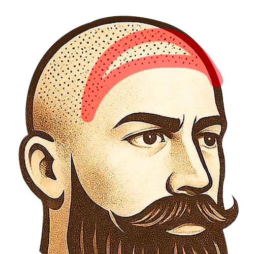 ヘアライン＋周辺（大）